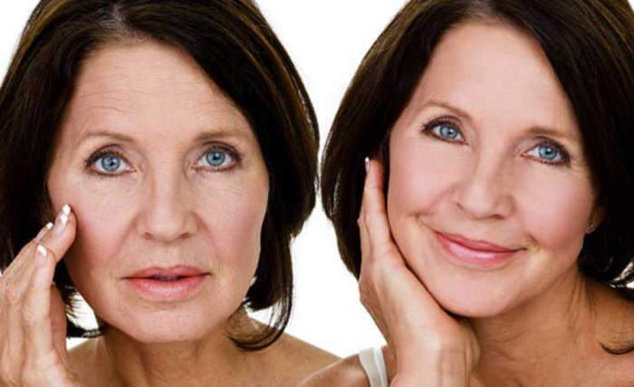 How long does it take for swelling to subside following a facelift?