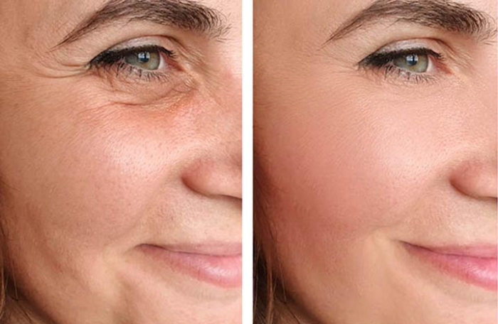 How does facelift surgery compare to other anti-aging procedures?