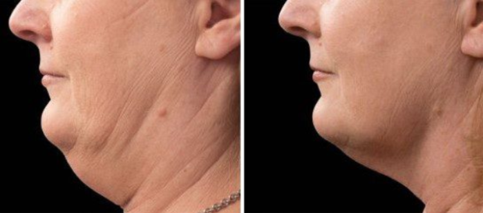 Are there non-surgical options for treating double chin and jowls?