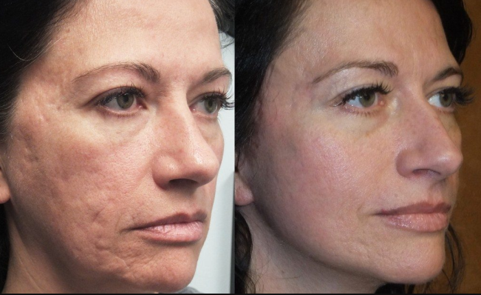 Can Facelift Surgery Result in Permanent Scarring