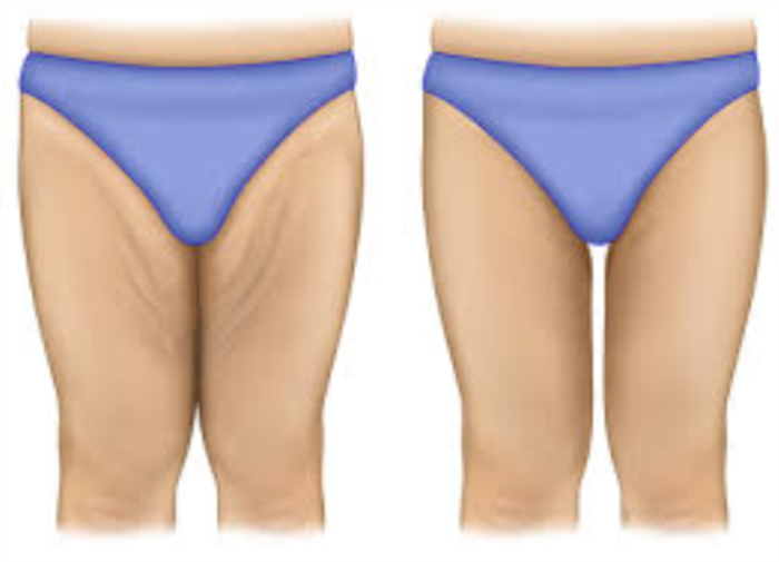 Is Sagging Skin on Your Thighs a Sign to Consider a Thigh Lift?