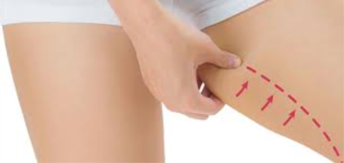 Can Uneven Thigh Contours Be a Reason to Opt for Surgery?