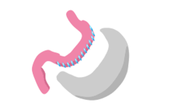 How Does the Success Rate of Revision Bariatric Surgery Compare to Primary Procedures?