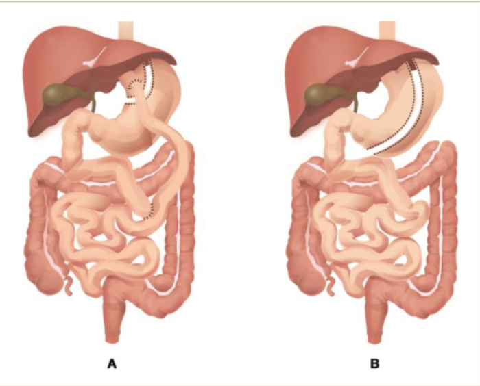 How Does the Risk of Infection Differ in Revision Bariatric Surgery Compared to Primary Surgery?