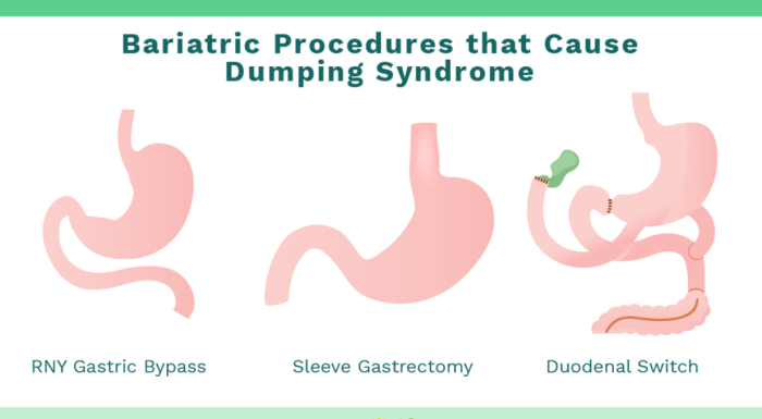 How Common is Dumping Syndrome After Revision Bariatric Surgery?