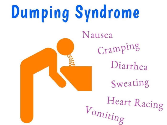 What Are the Long-Term Effects of Dumping Syndrome After Bariatric Revision Surgery?