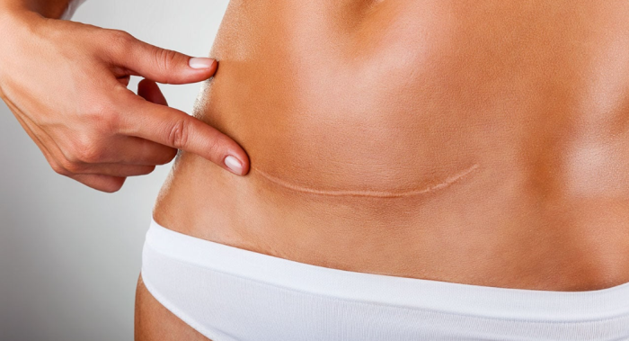 How Long Do Tummy Tuck Scars Take to Heal?