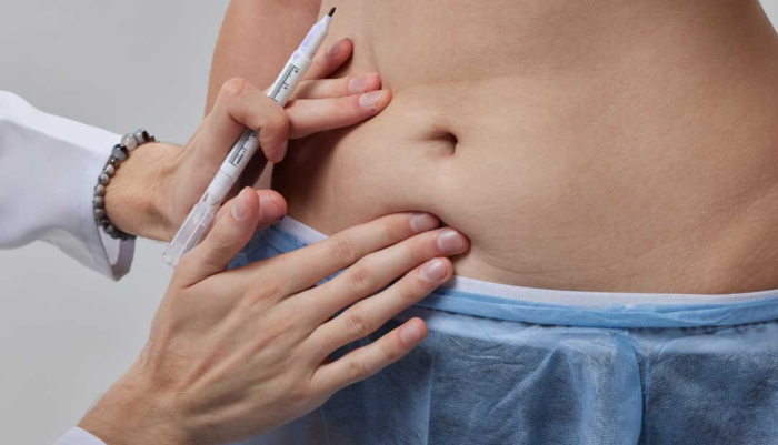 Can tummy tuck surgery lead to infection?