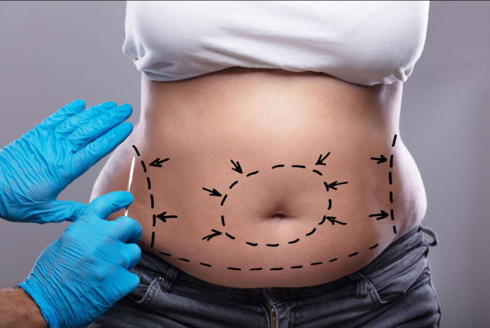 How can smoking impact the risks associated with tummy tuck surgery?