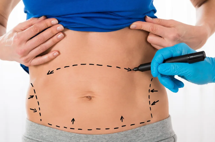 How does the cost of a tummy tuck in India compare to other countries?