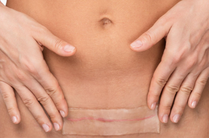 How can you prepare for a smooth tummy tuck recovery?