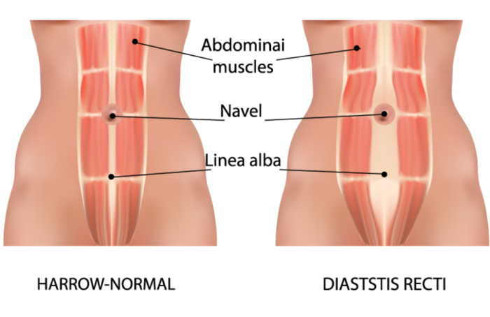 Are There Alternatives to Muscle Repair in Addressing Diastasis Recti?