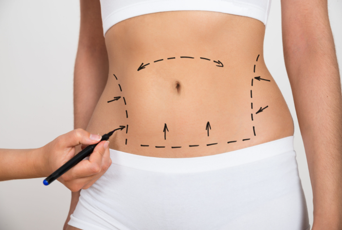 How Is Full Body Lift Surgery Different from a Tummy Tuck in Improving Body Contour?