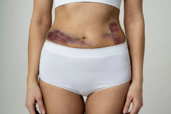 Preventing Hematomas After Full Body Lift Surgery