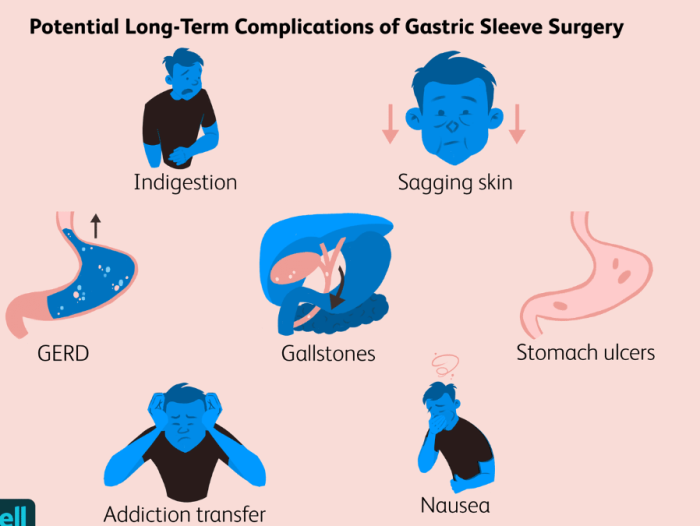 Peritonitis: A Rare but Serious Complication of Mini Gastric Bypass