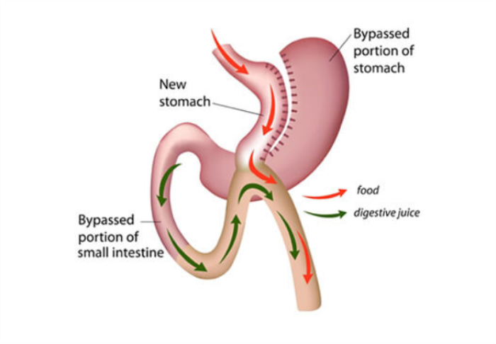 Why India is a Popular Destination for Mini Gastric Bypass Surgery