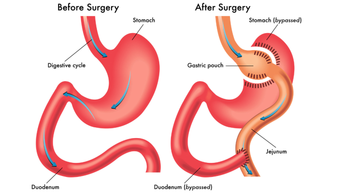 How Mini Gastric Bypass Differs from Traditional Gastric Bypass