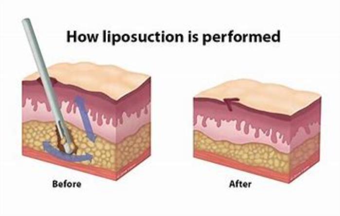 Best Hospitals for liposuctions in india