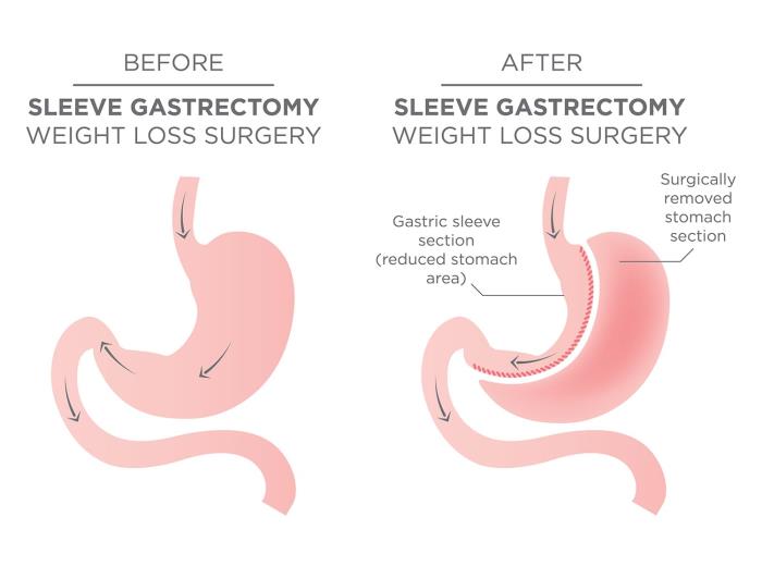 Post surgery care and recovery of Sleeve Gastrectomy Surgery in India 