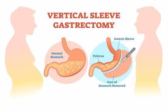 Preparing for Sleeve Gastrectomy Surgery