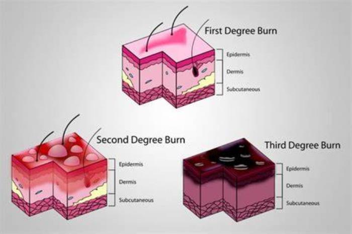 Best treatment options for serve burn treatment 