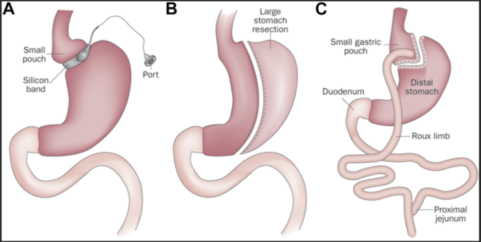 Best Laparoscopic Adjustable Gastric Banding (LAGB) Surgery Hospital in India