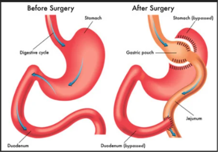 Best Hospital for Roux-en-Y Gastric Bypass (RYGB) Treatment in India