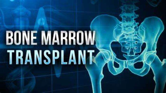 Common Complications After Bone Marrow Transplant