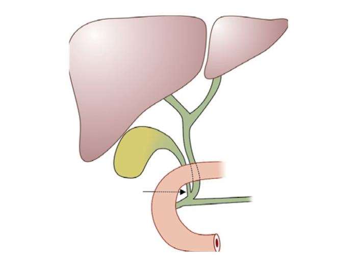 Common Types of Post Liver Transplant Medications