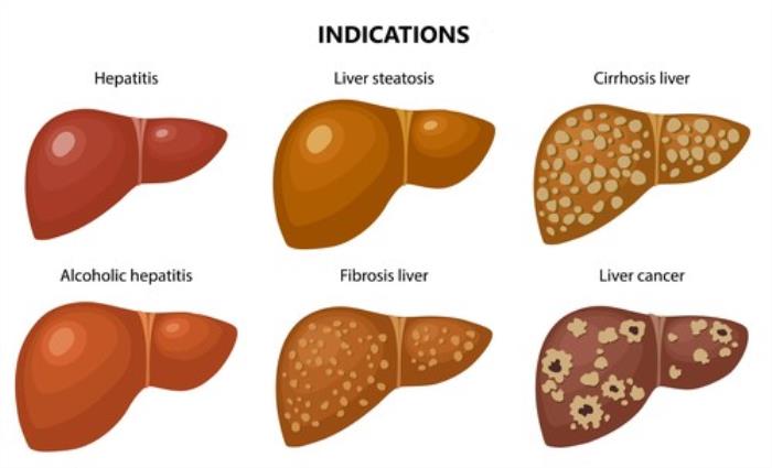 Types of Liver Transplants Performed in India