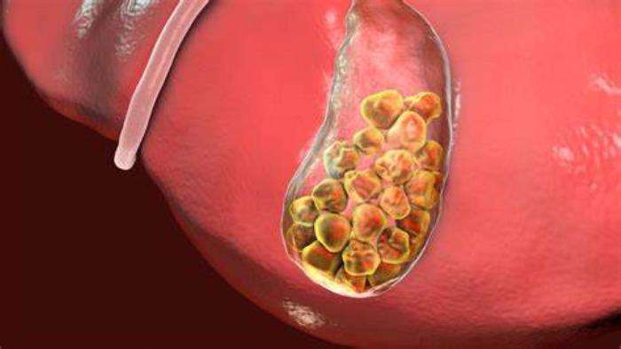 Symptoms Indicating Bile Duct Issues After Transplant