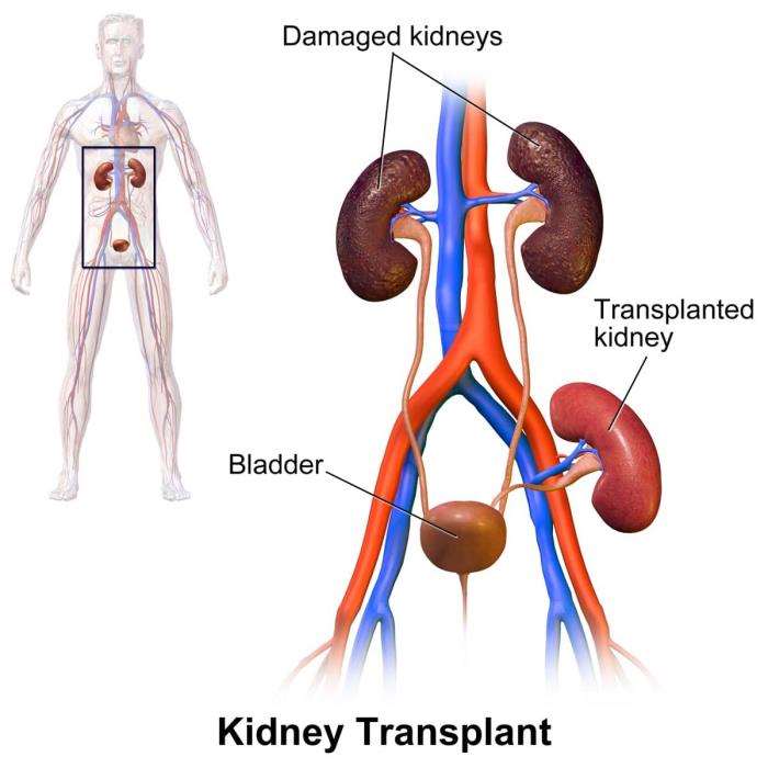 Managing Medications After Kidney Transplant Surgery