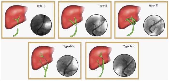 Bile Duct Complications Following Liver Transplantation