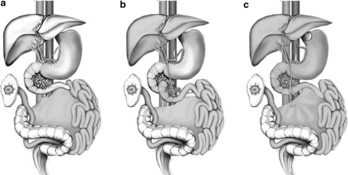 The Effect of Intestine Transplant on Nutrient Absorption