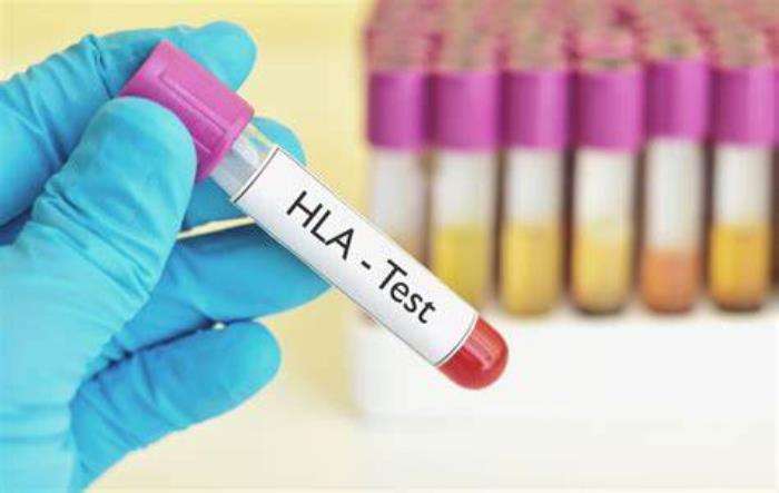 HLA Matching Process in Transplantation