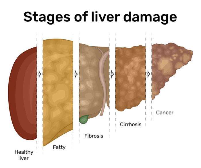 The Stages of Liver Cirrhosis and Its Progression