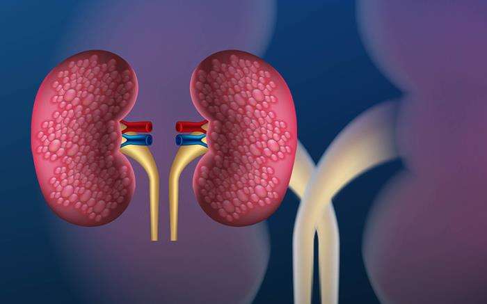 How Diabetes Affects the Success of Kidney Transplantation