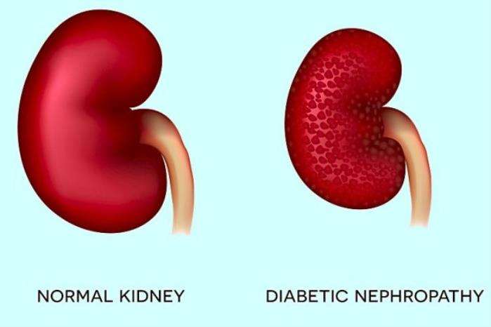 Risk of Recurrence of Diabetic Nephropathy After Kidney Transplant