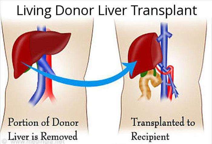 Patient Selection Criteria for Liver Transplant