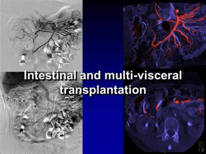 Indications for Multivisceral Transplantation