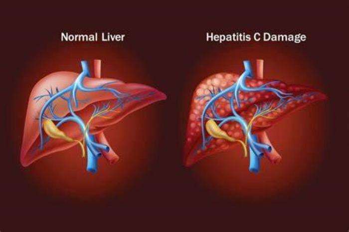 The Link Between Hepatitis C and Liver Failure