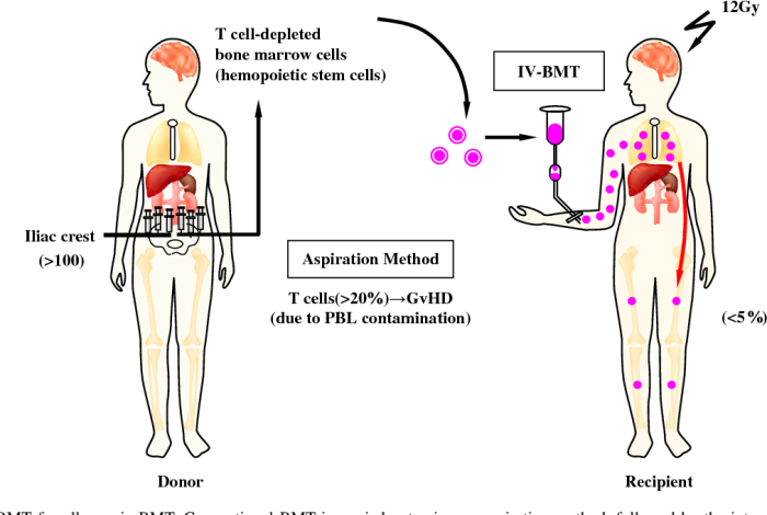 Indications for Bone Marrow Transplant in Lymphoma