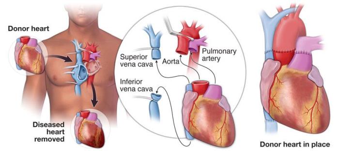 How Immunosuppressive Therapy Supports Recovery After Transplantation