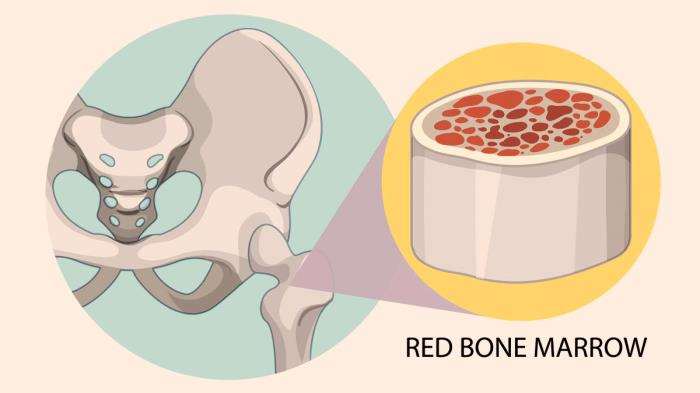 Success Rates of Bone Marrow Transplants in Lymphoma