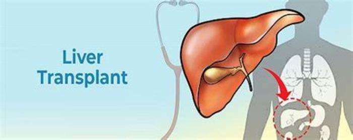 When Is Liver Transplantation Considered for Liver Cancer Patients