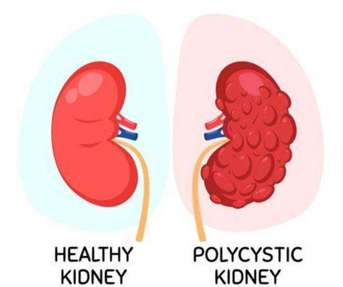 How Polycystic Kidney Disease Affects Kidney Health Over Time