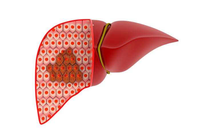 The Benefits of Liver Transplant Over Other Cancer Treatments