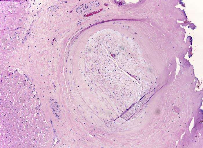 Coronary Allograft Vasculopathy