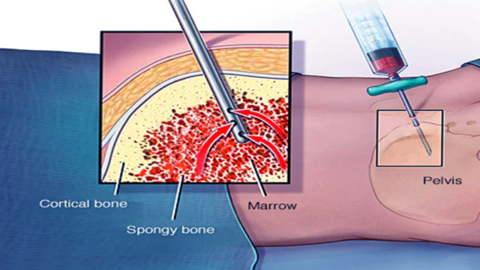 Why Some Anemia Patients Need a Bone Marrow Transplant