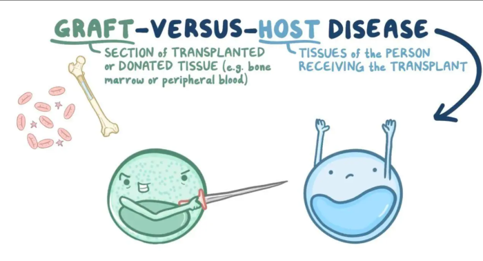 Understanding Graft vs. Host Disease (GVHD) After Bone Marrow Transplants